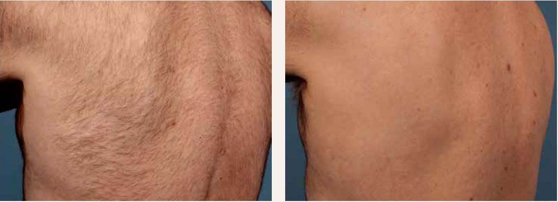 Laser hair removal before and after - Full back &mdash; significant clearance after a course