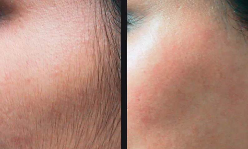Laser hair removal before and after - Facial hair &mdash; smoother, clearer skin after a course