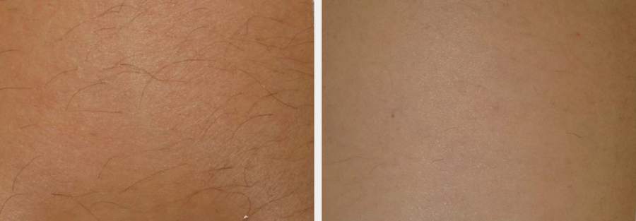 Laser hair removal before and after - Body hair &mdash; visible reduction after just 3 treatments