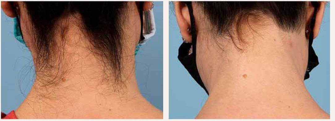 Laser hair removal before and after - Neckline &mdash; clean, defined results