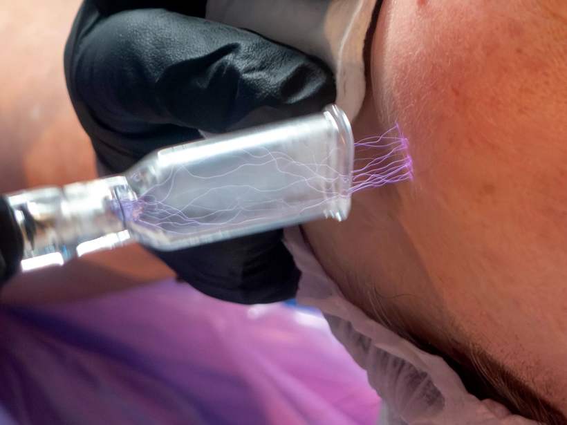 Cold plasma therapy in action
