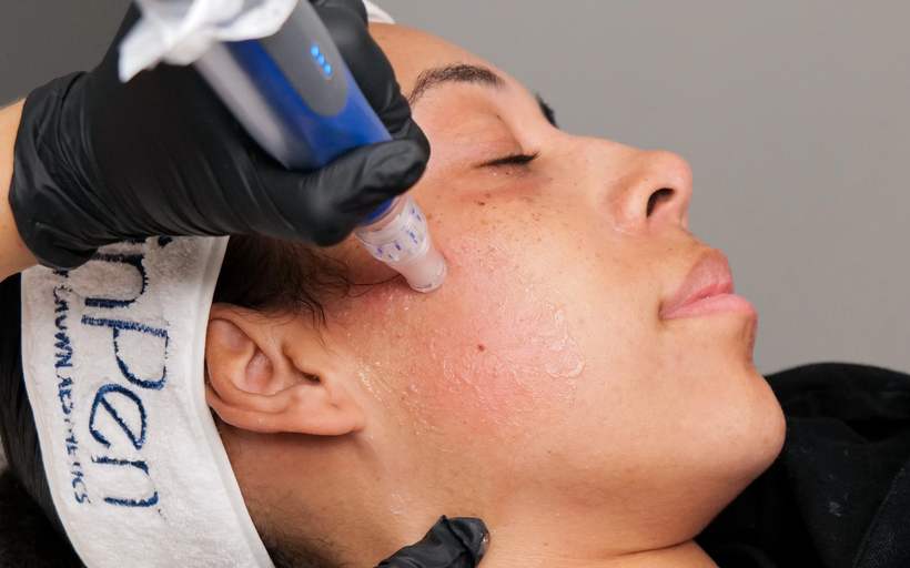 Microneedling treatment with SkinPen