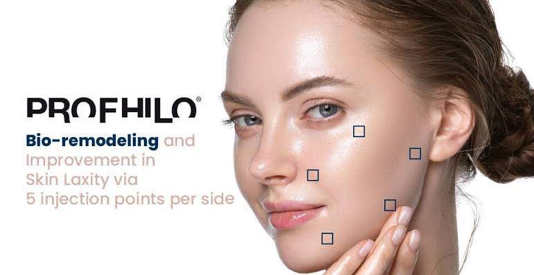 Profhilo bio-remodelling treatment injection points