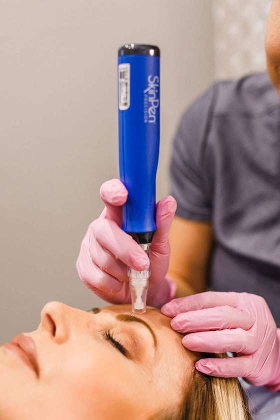 Microneedling with SkinPen